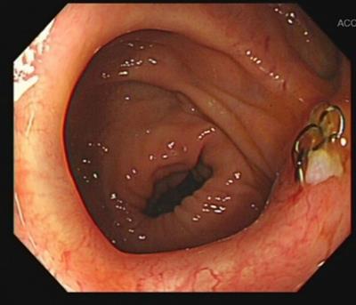 Resolution of occult anastomotic stricture with anal dilator: challenges with the conventional diagnostic criteria in low anterior rectal resection patient—a case report